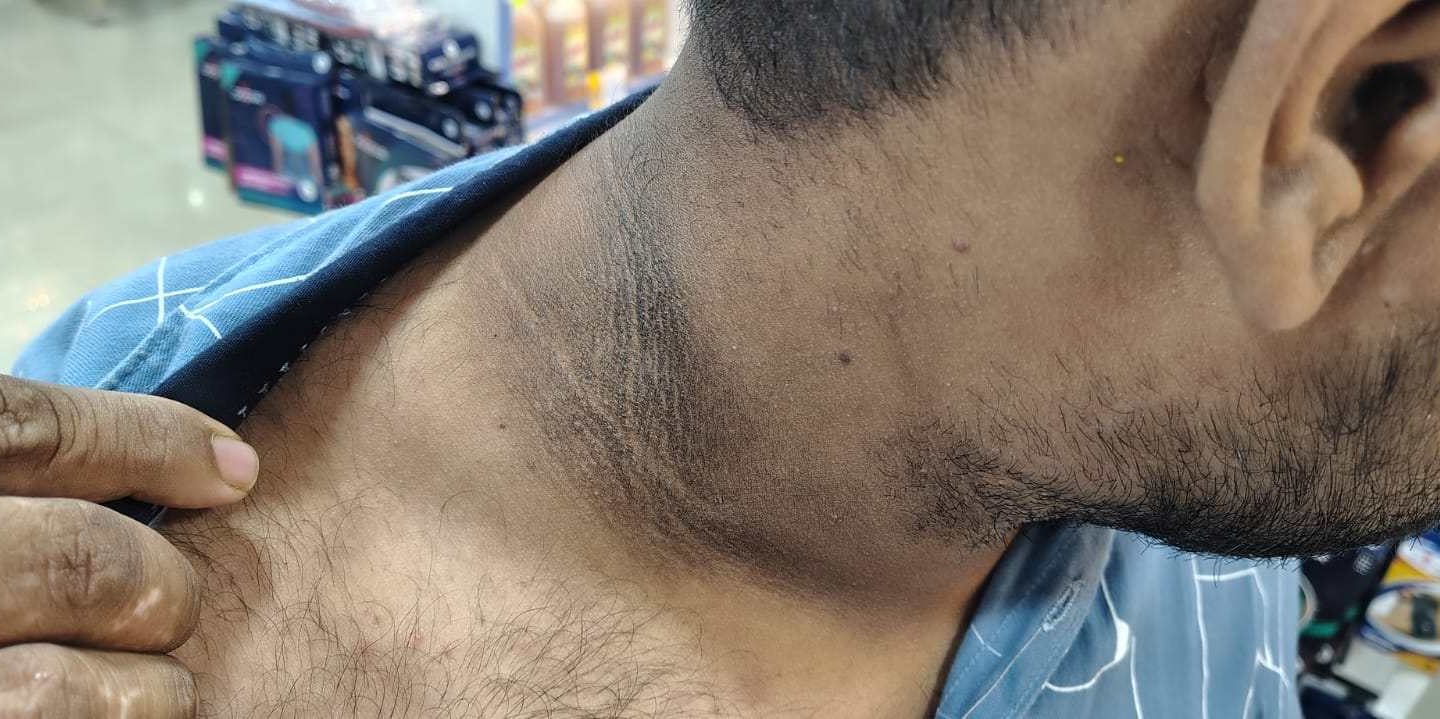black neck natural treatment