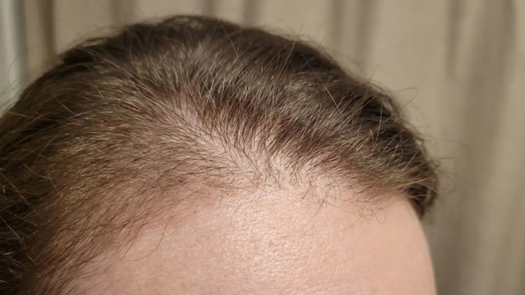 Hair thinning caused by DHT hormone affecting hair follicles