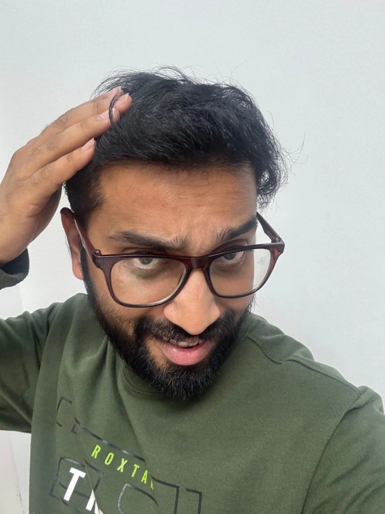 abhishek chouhan stopped minoxidil and result after one year